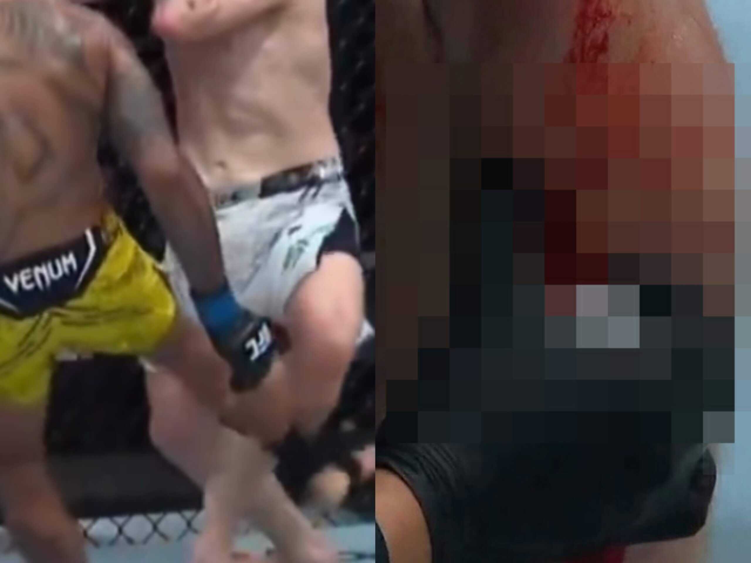 VIDEO: Len pre silné žalúdky! UFC zápasník rozstrieľal súperovu nohu, krv tiekla potokom