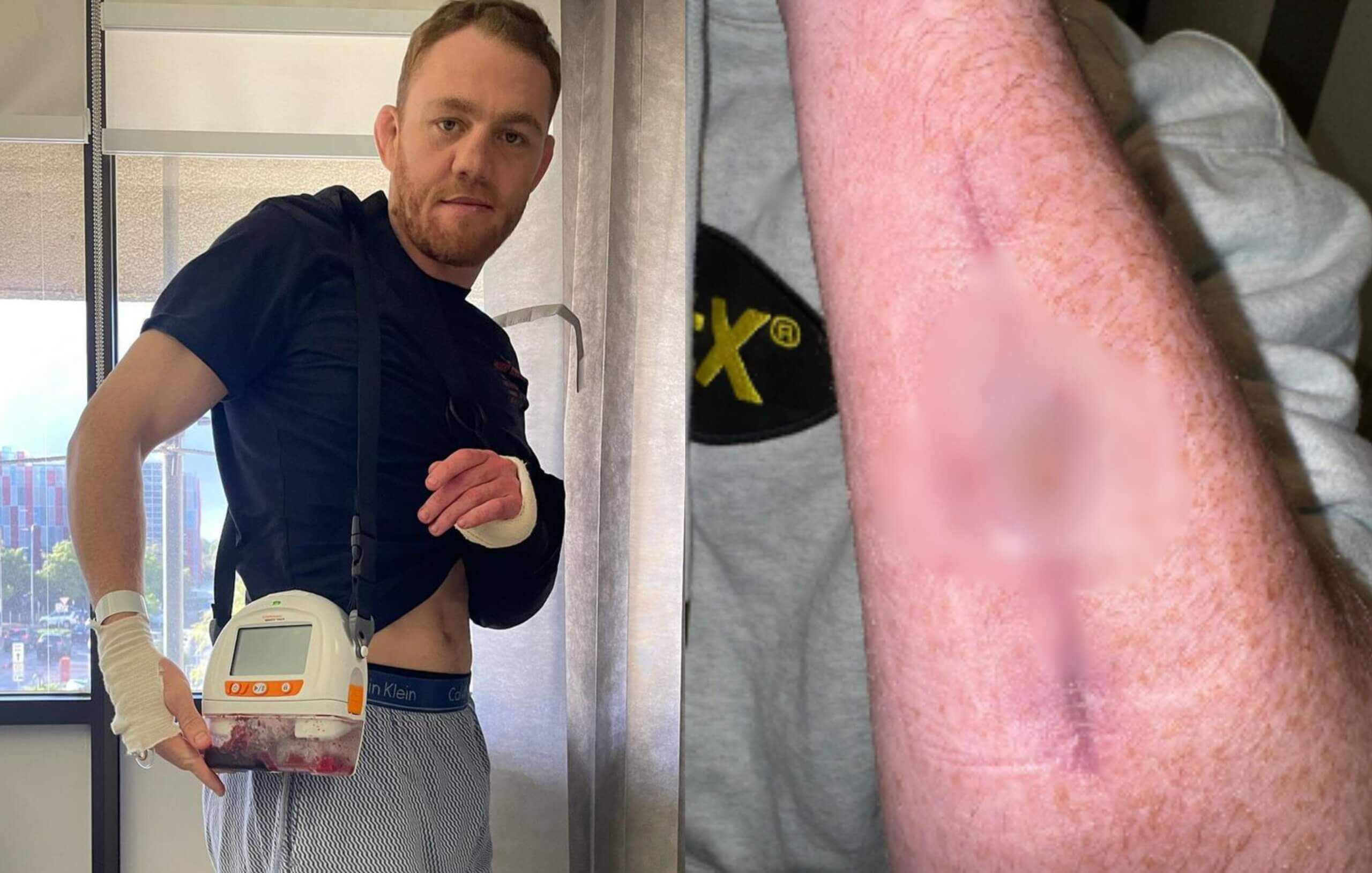 VIDEO: Nič pre citlivé povahy. Hviezdny postrach z UFC bojuje s nechutnou infekciou
